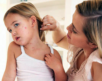 Bệnh thủy đậu (còn gọi là bệnh trái rạ) bệnh do virus Varicella zoster gây ra. Bệnh chủ yếu ở trẻ em.